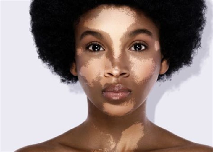 Can vitiligo make you deaf?