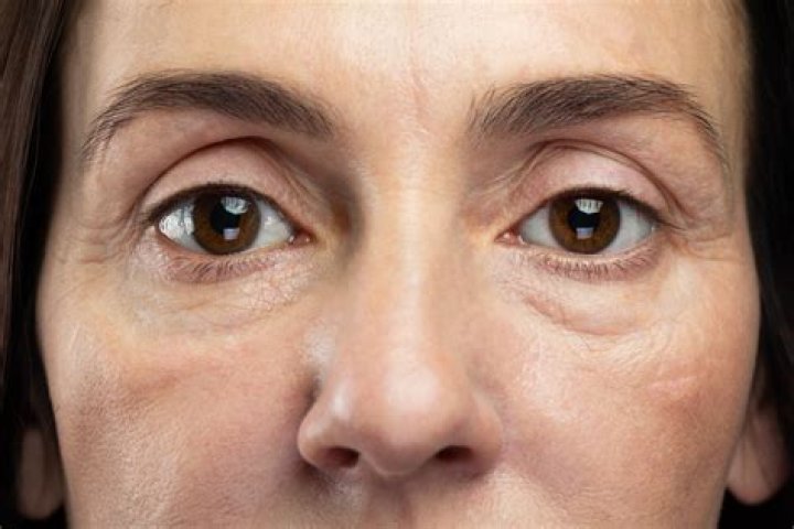 How do you treat baggy eyes?
